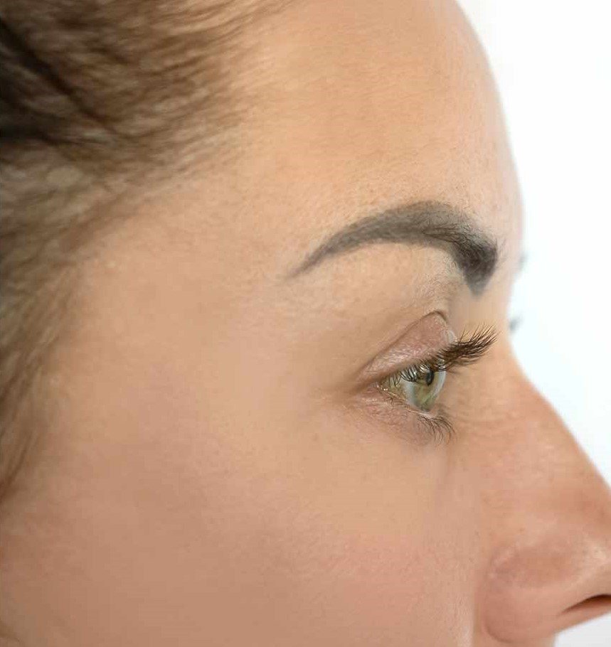 Hypopigmentation after