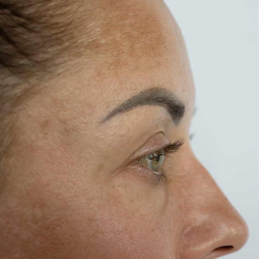 Hypopigmentation before